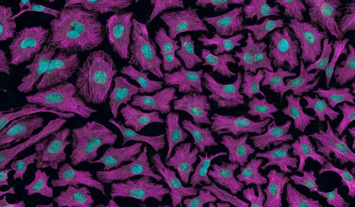 Cancer cells under microscope